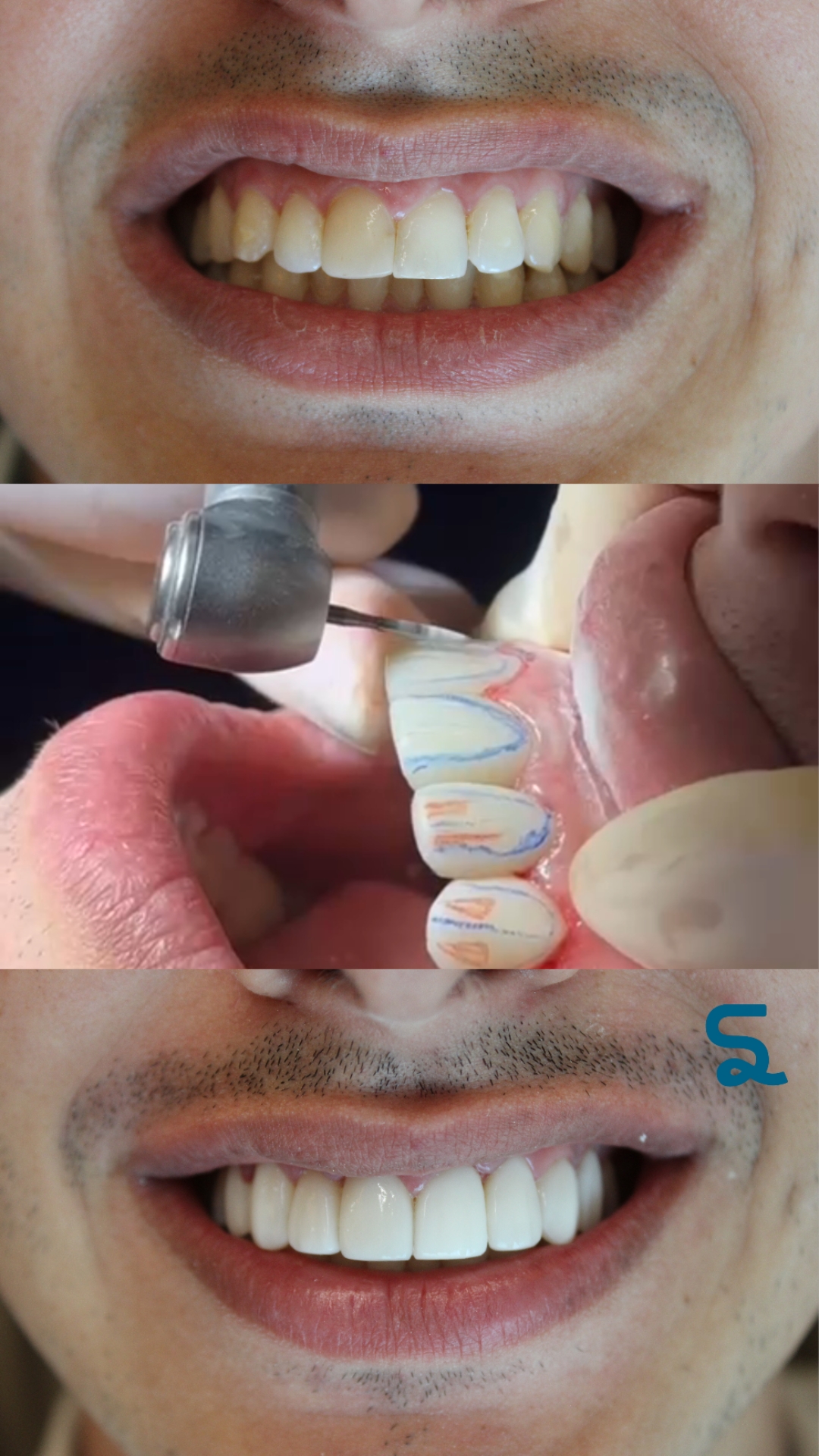 PACIENTE ADAILSON - CLAREAMENTO + FACETA