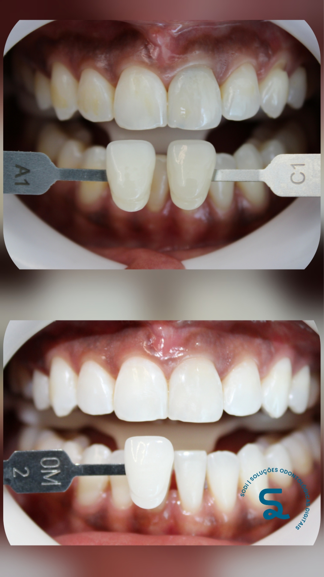 PACIENTE PRISCILA - CLAREAMENTO 2