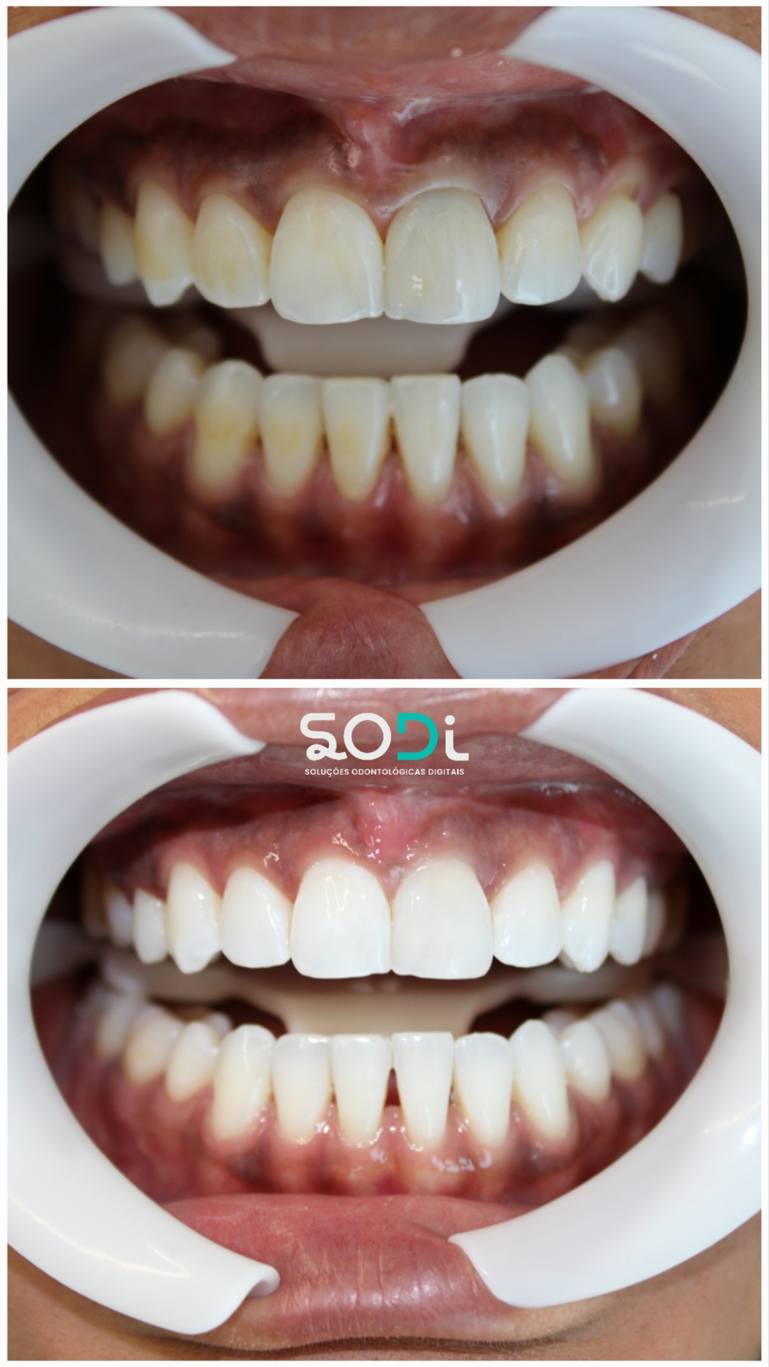 PACIENTE PRISCILA - CLAREAMENTO