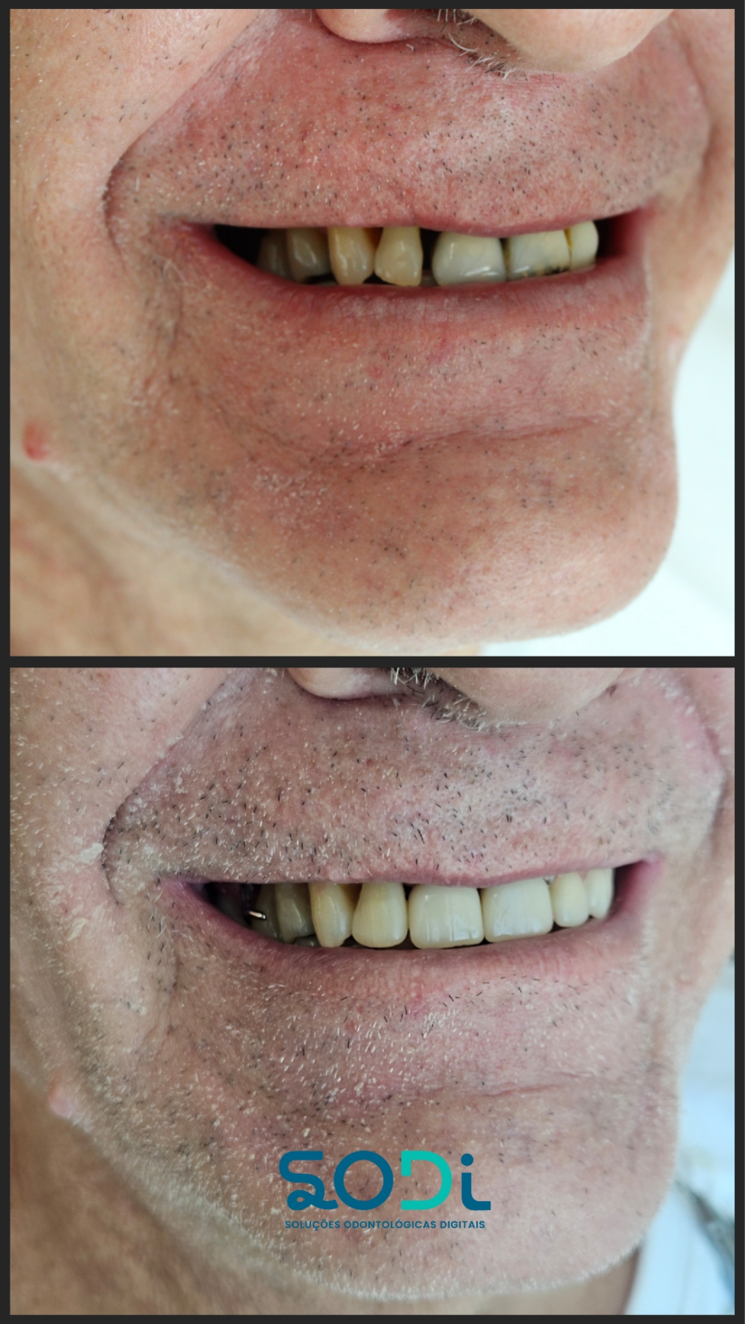 PACIENTE RENÊ - COROA E PRÓTESE